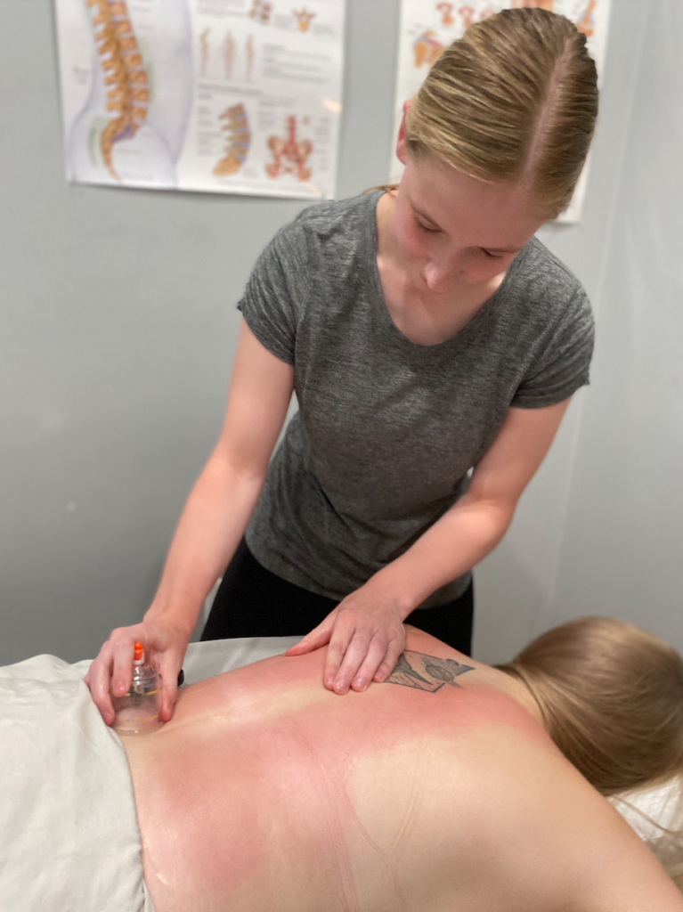 Cupping Therapy: What Is it, Benefits & Common Conditions Treated