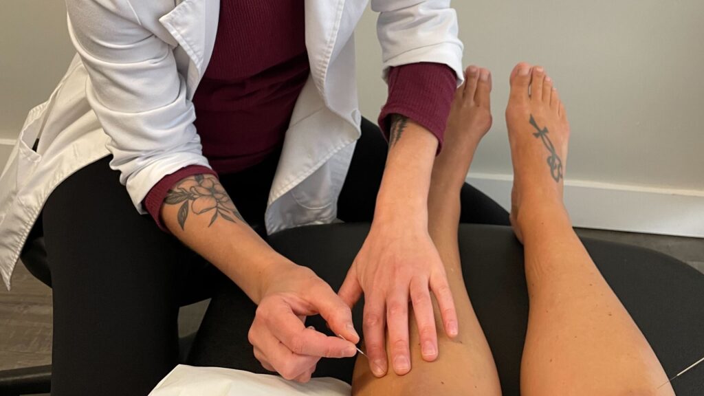 How Acupuncture Can Help With Managing Stress & Anxiety