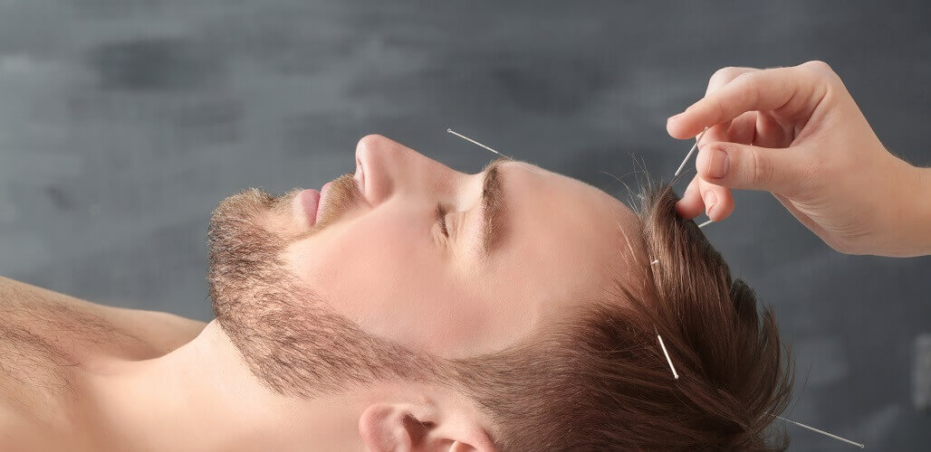 How Acupuncture Can Help Relieve Headaches