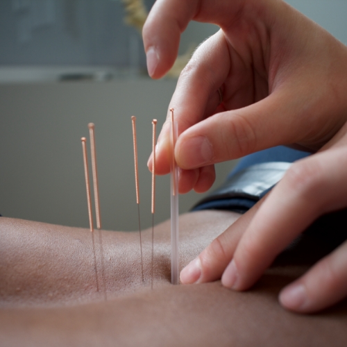 Acupuncture-Page-Photo-Choice-Health-Centre-Dartmouth-NS.jpg