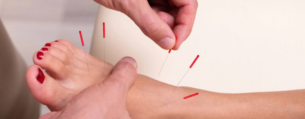How Acupuncture Aids Recovery After Injury