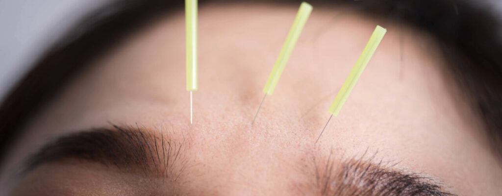 How Acupuncture Can Help Reduce Chronic Headaches